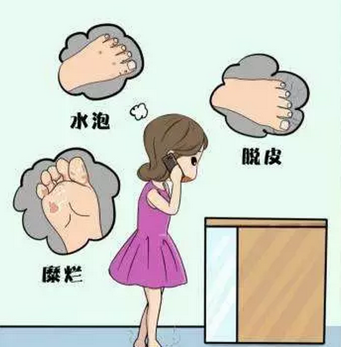 脚气怎么治